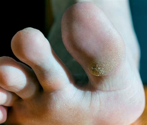 Бородавка под ногтем на пальце ноги - причины и лечение